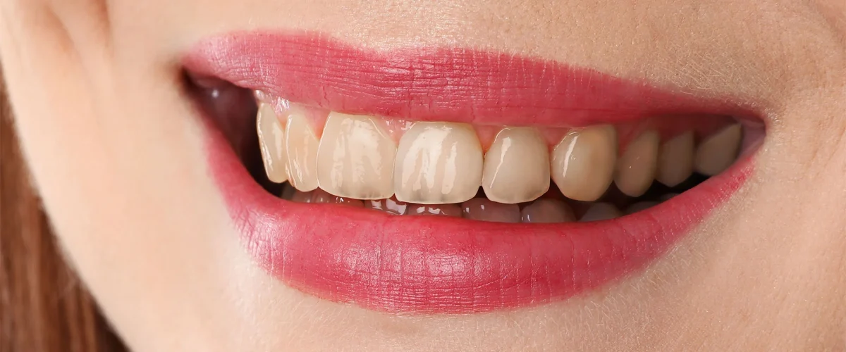 dental-before